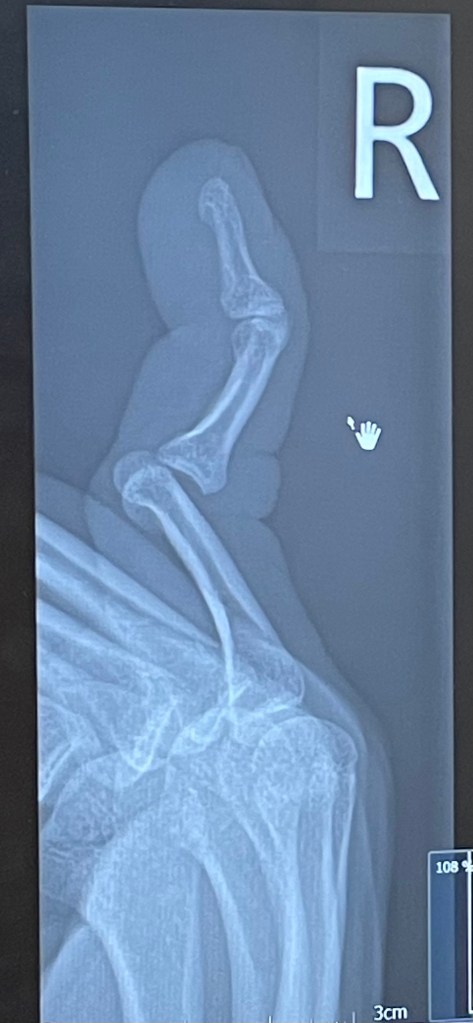 x-ray of a dislocated finger
